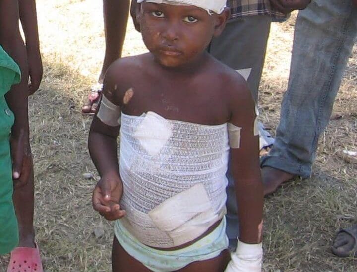 Haiti Earthquake - Pediatric Injuries